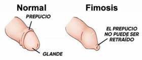 Conos extensores para fimosis, solución prepucio apretado adultos